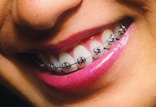 smartclip_brackets.jpg